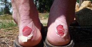 blisters